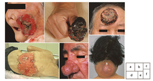 皮膚腫瘍患者の受診動機調査 皮膚癌の早期発見のために 新潟市医師会報より